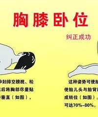 每天做膝胸卧位操"