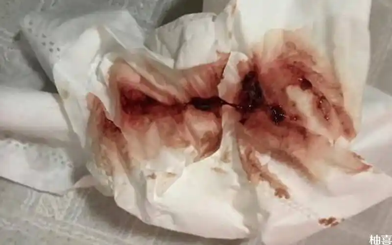 囊胚移植第3天出血别担心多可能是宫颈粘膜受刺激造成