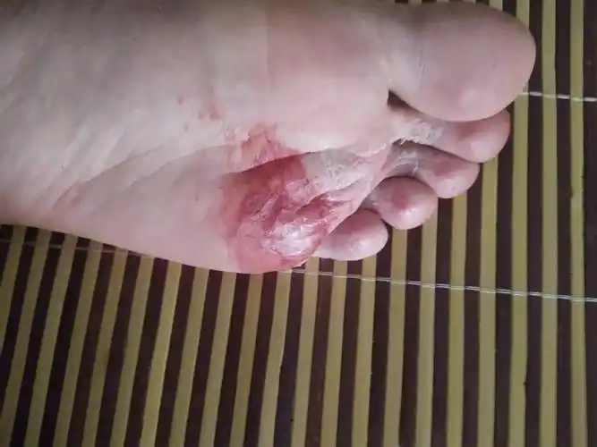 这几周每天都穿鞋子然后脚闷到都脱皮了,之前穿几天我就穿拖鞋然后