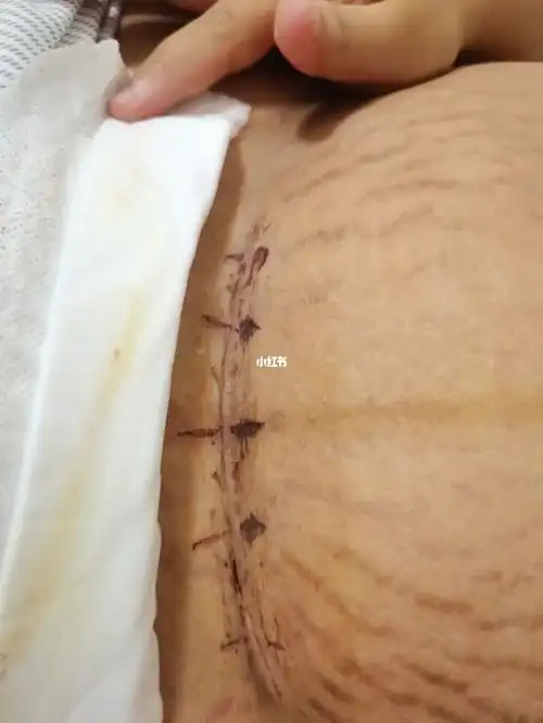 剖腹产第8天希望快快恢复