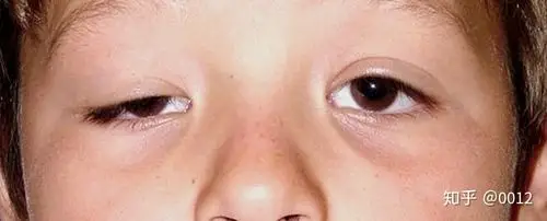 重症肌无力影响你步入幸福生活的一道坎