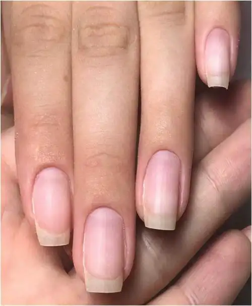 常见的四大问题指甲急