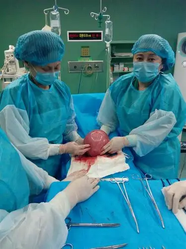 妇产科完成巨大子宫肌瘤手术一例