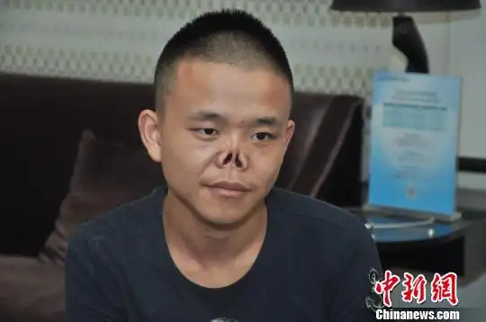 24岁"无鼻男孩"新鼻子成型:新爱好是自拍
