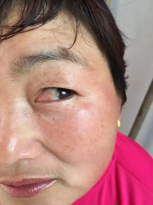帮忙看看相片中的人的眼睛得的是什么病?严重吗?怎么治疗?