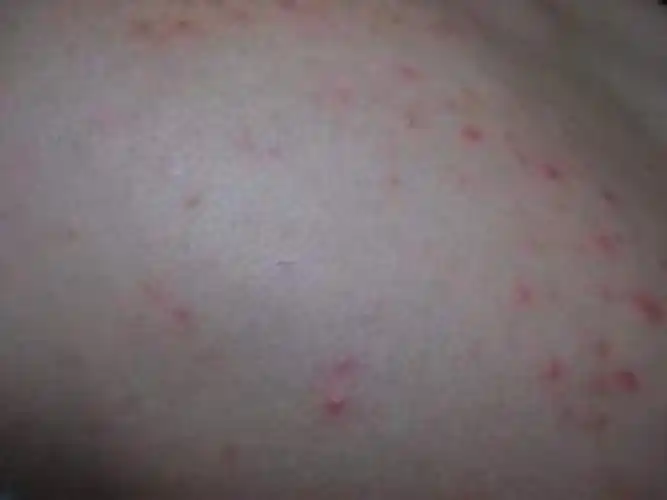 阴茎长毛囊炎的症状图片