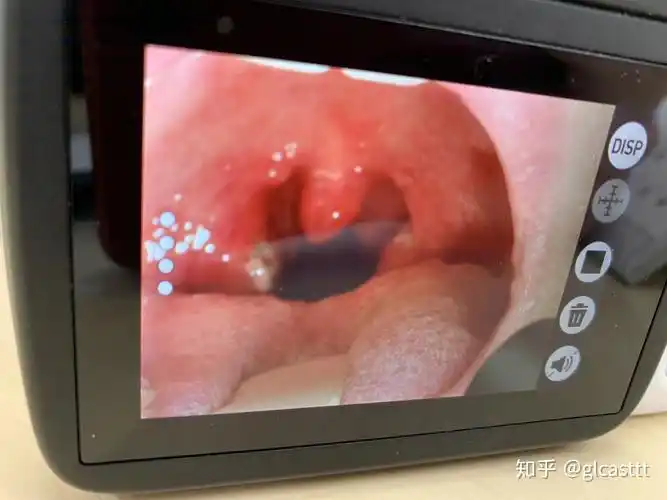 这个是脓包还是溃疡呢... - 知乎