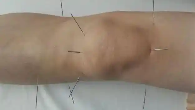 施今墨中医治疗膝关节骨性关节炎针灸疗法