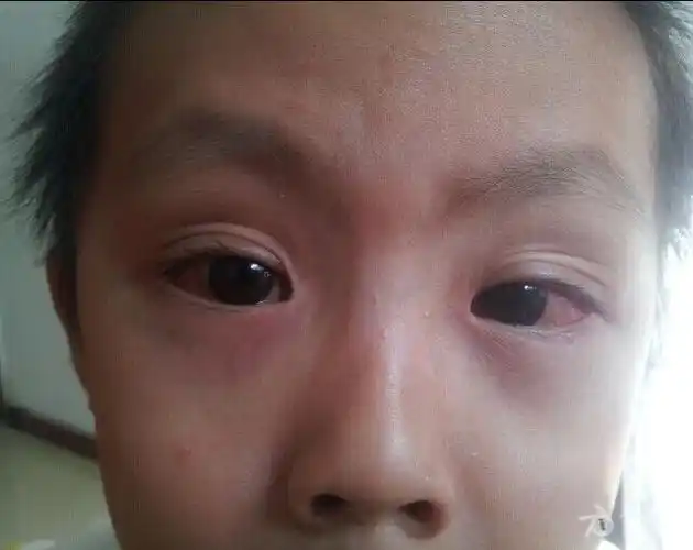 5岁 小朋友过敏性结膜炎,看有无好办法