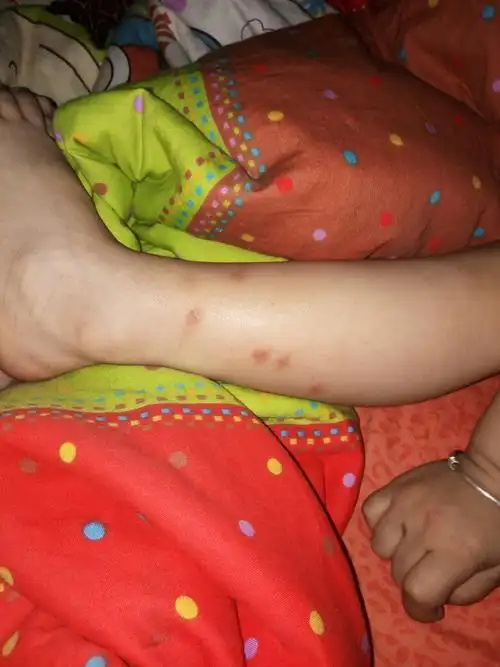 孩子身上每年这个时候都会起很多这样的大红疙瘩 而且