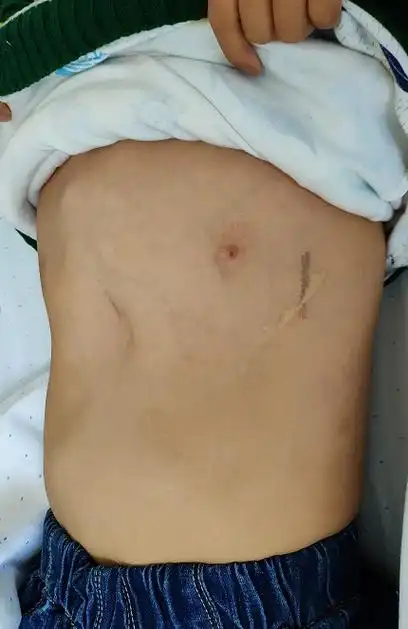 第二台手术由于是二次手术,考虑到胸骨与心脏的粘连,无法