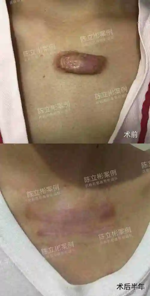 胸部疤痕疙瘩术后半年随访