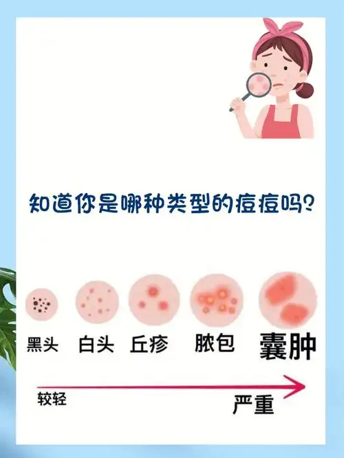 教你认清自己属于什么类型痘痘