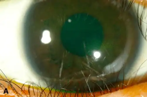 让妈妈们困扰的倒睫,是怎么一回事?