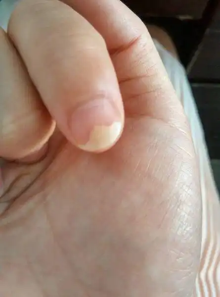 指甲盖为什么会莫名其妙的空呢?