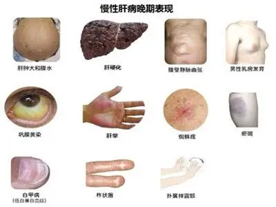 如何早发现肝癌,高发人群你知道吗?