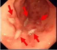 几张胃溃疡图片