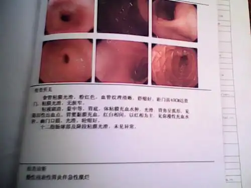 慢性浅表性胃炎