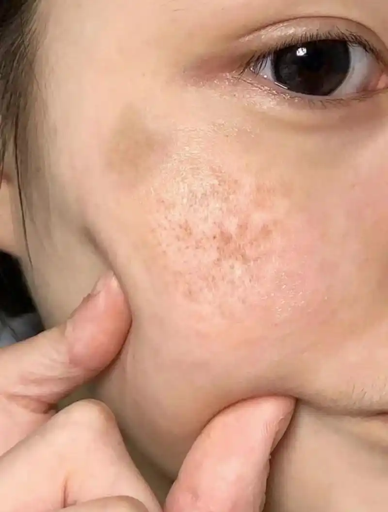 大片的黄褐斑怎么去除?