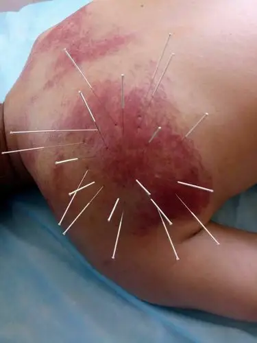 靖边县长庆路,永宁路,天天快递,电话13891238599 写美篇还在为肩周炎