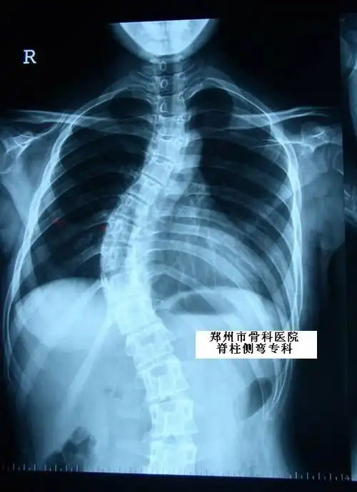 病例:女,14岁,特发性脊柱侧凸,中华长城三维矫正术后.