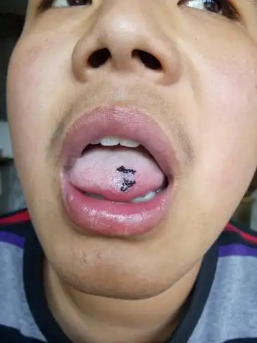 我的舌头尖上左侧有个乳头前天动术了为什么三天了舌头只要一吃饭疼的