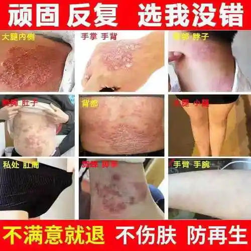 顽固型牛皮藓神经性皮炎治疗手脚体股头藓癣真菌感染中药膏断根