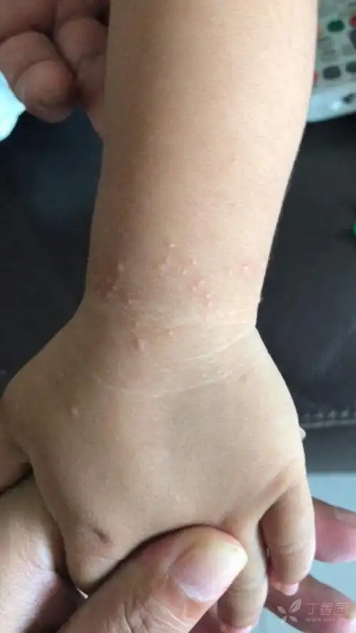 小儿腕部皮疹待诊