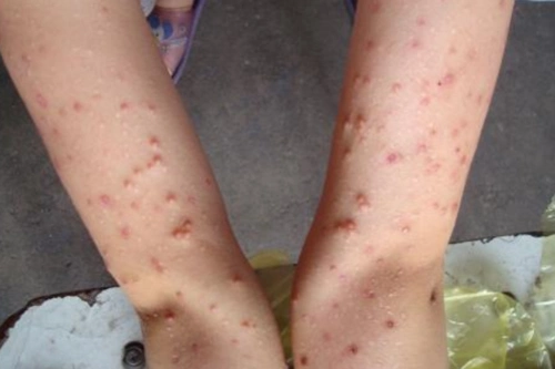 儿童软疣图片 (20)_有来医生