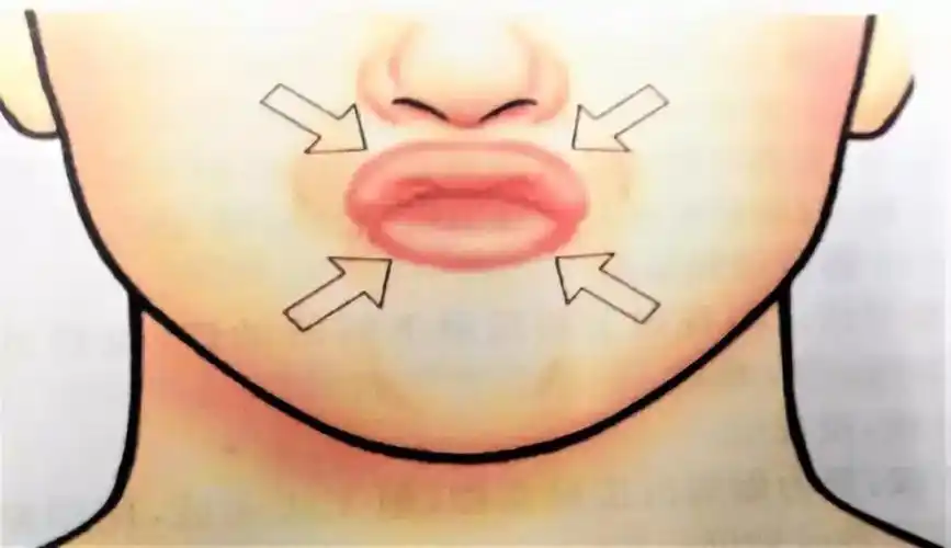 口腔运动之圆唇运动治疗