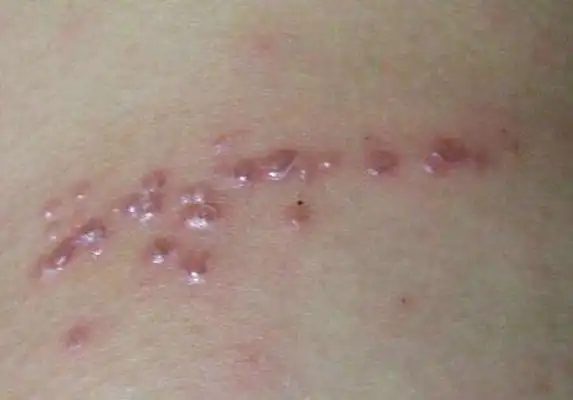 蛇缠腰早期症状图 (15)_有来医生