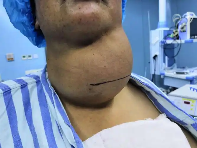 勉县医院多科协做,成功切除一巨大甲状腺瘤