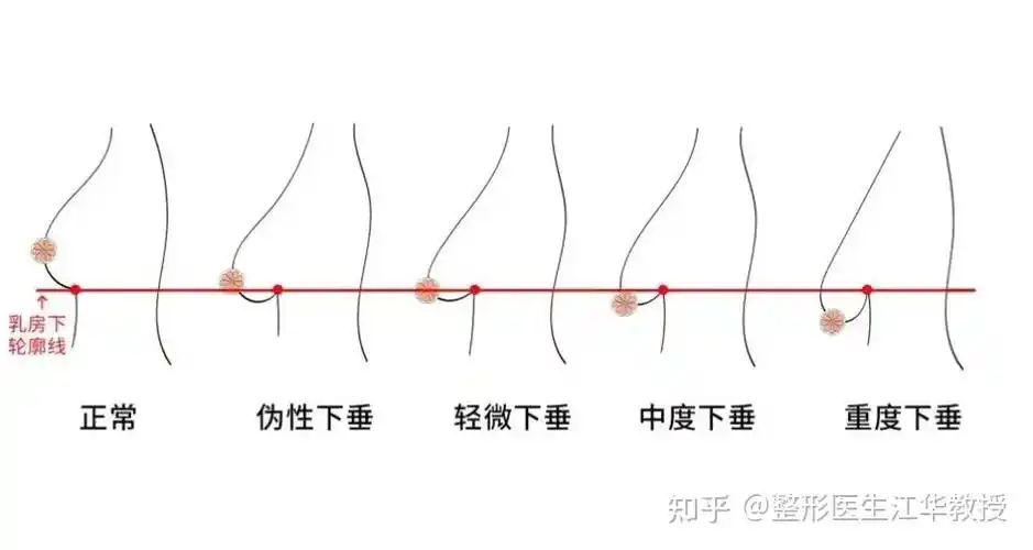 乳房下垂都是怎么看出的,分程度? - 知乎