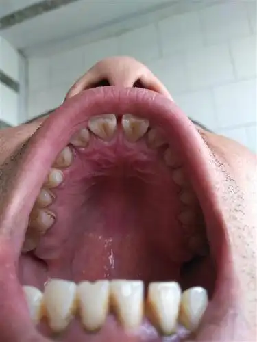 上颚疼【多图】_39医疗图集-39健康网