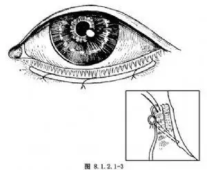 先天性睑内翻矫正术