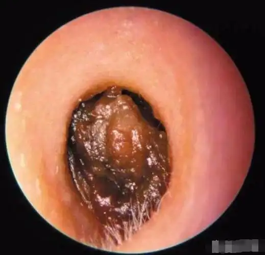 为什么人的耳朵会分成油耳和糠耳