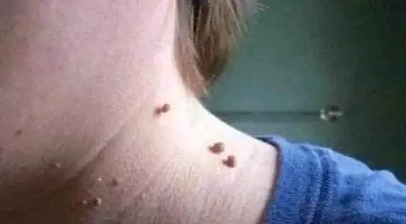 菜花病 (27)_有来医生