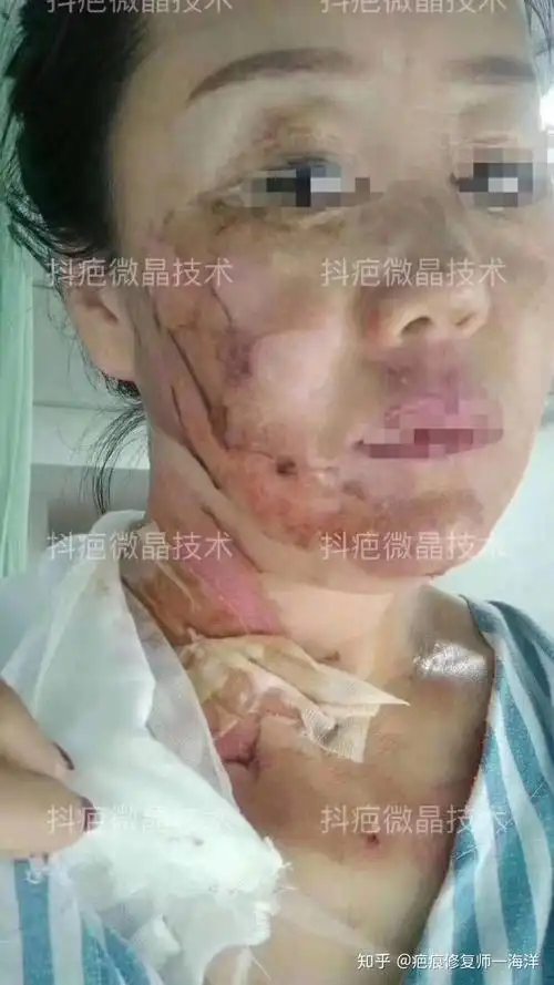 烧伤疤修复前后对比照