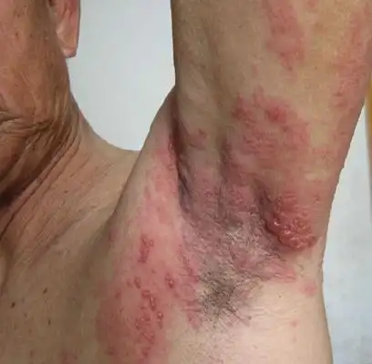 艾滋初期皮疹图片40