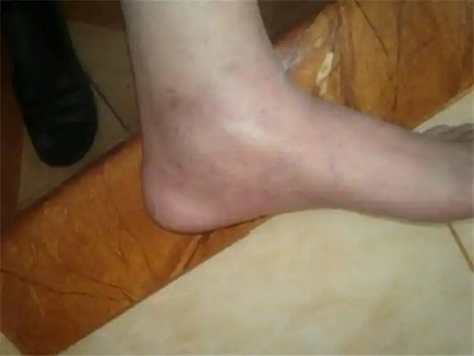 足部浅表型静脉炎图片