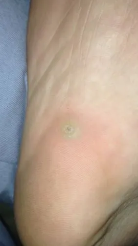 脚板上的鸡眼长了四个月了