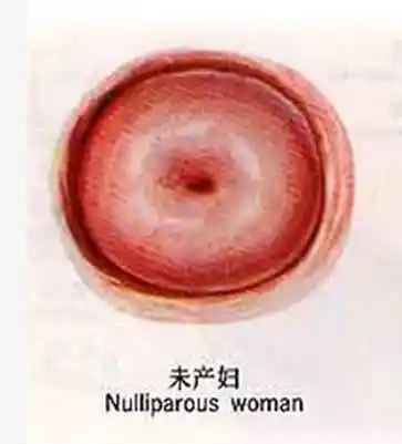 生育过的女性宫颈口呈"-"型