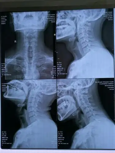 写美篇上下角骨质增生,变尖,边缘硬化;下段颈椎5/6椎间隙变窄,前纵