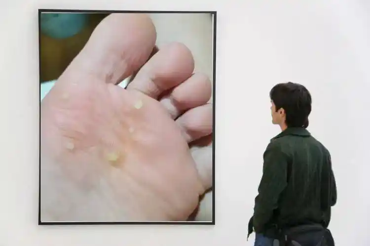 10岁男孩感染hpv:小屁孩假期都做了些什么?原来是宝妈的原因_角质_足