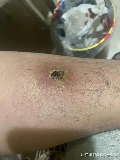 人体的火疖子 (化脓性毛囊及毛囊深部周围组织的感染) 能有多大?