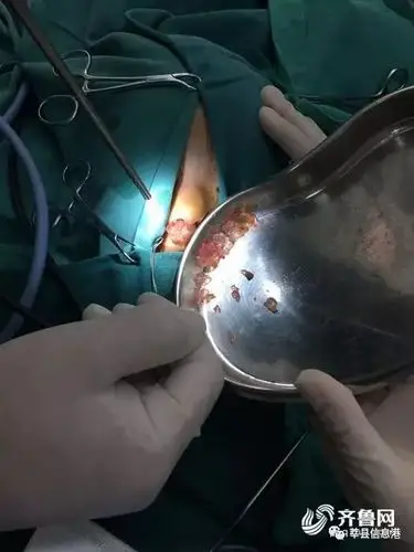 聊城2岁男孩眼肿胀 医生从鼻内取出"海绵宝宝"!