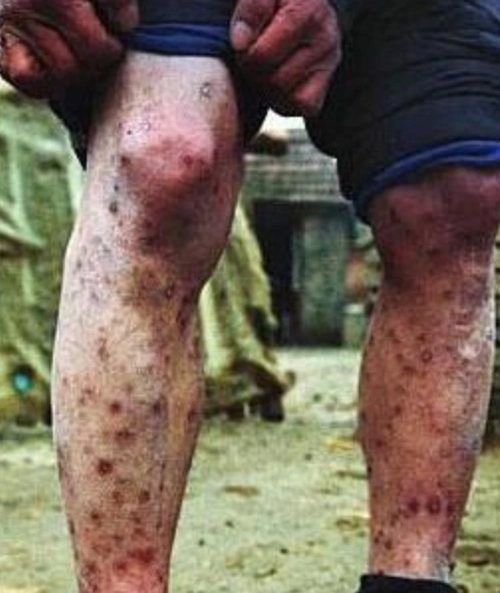 艾滋病舌部图片