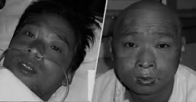 日本一男子中"核辐射",医生为了做实验,强行让他活了两个月