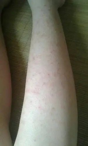 十二岁,小腿皮肤干燥,长子子,是什么?