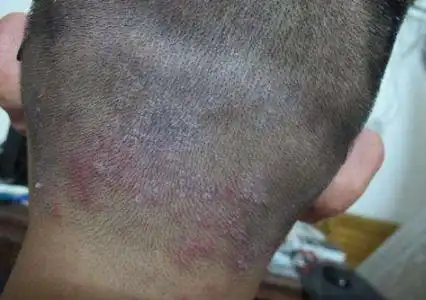 头皮型银屑病图片 (31)_有来医生